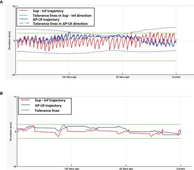 The delivered dose assessment in pancreas SBRT with the target position determined using an in-house position monitoring system